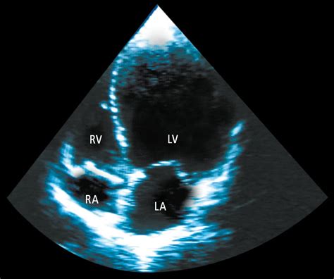 lv dilation with vsd|dilated cardiomyopathy sudden death.